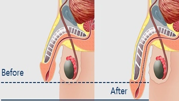 Penis Enlargement Treatment Process